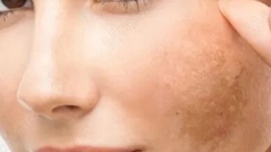 علت ایجاد لک‌های پوستی و راه درمان آن